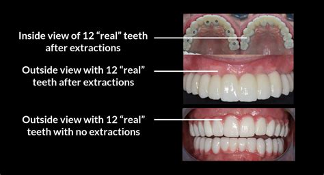 Bionic smile - All-on-4 Implants full upper or lower set of 12 "real" zirconia teeth permanently screwed on 4 implants $8,999 or Payment Plan $350/month